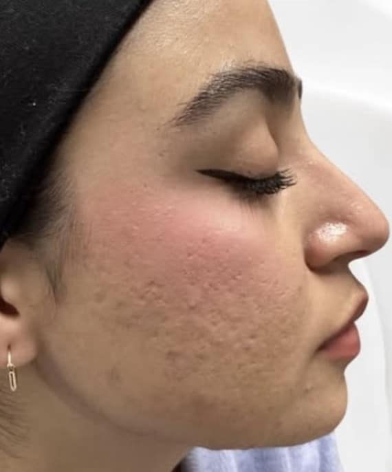 After Image: Acne on Face Side Profile - right-side