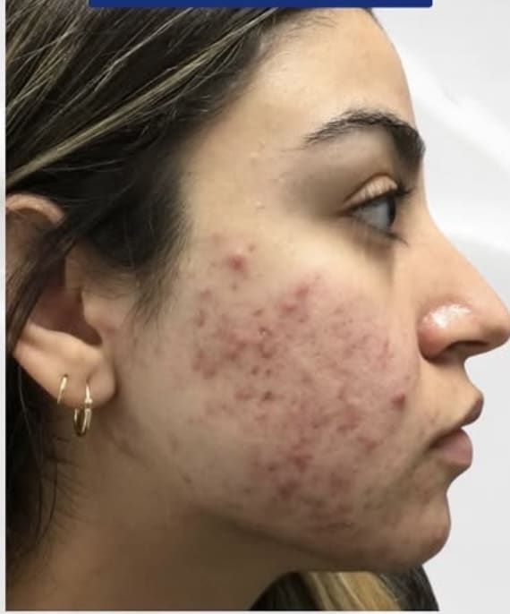 Before Image: Acne on Face Side Profile - right-side