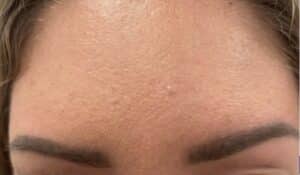 After Image: Botox Cosmetics Crows Feet