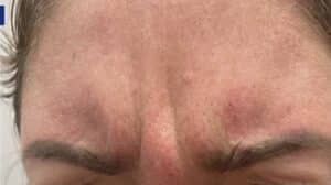 Before Image: Botox Cosmetics Crows Feet