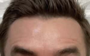 After Image: Botox Cosmeticson Forehead