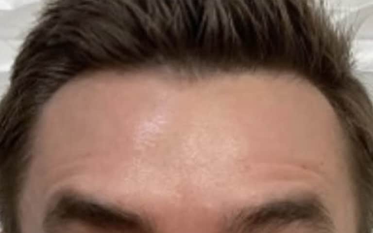 After Image: Botox Cosmeticson Forehead - front