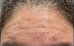 Before Image: Botox Cosmeticson Forehead