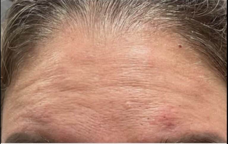 Before Image: Botox Cosmeticson Forehead - front