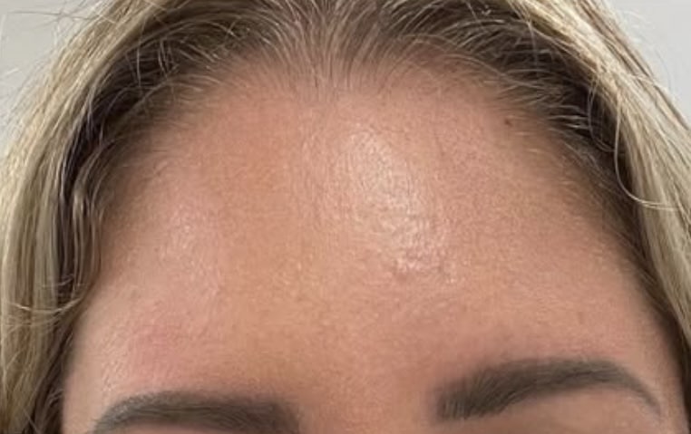 After Image: Botox Cosmeticson Forehead - front