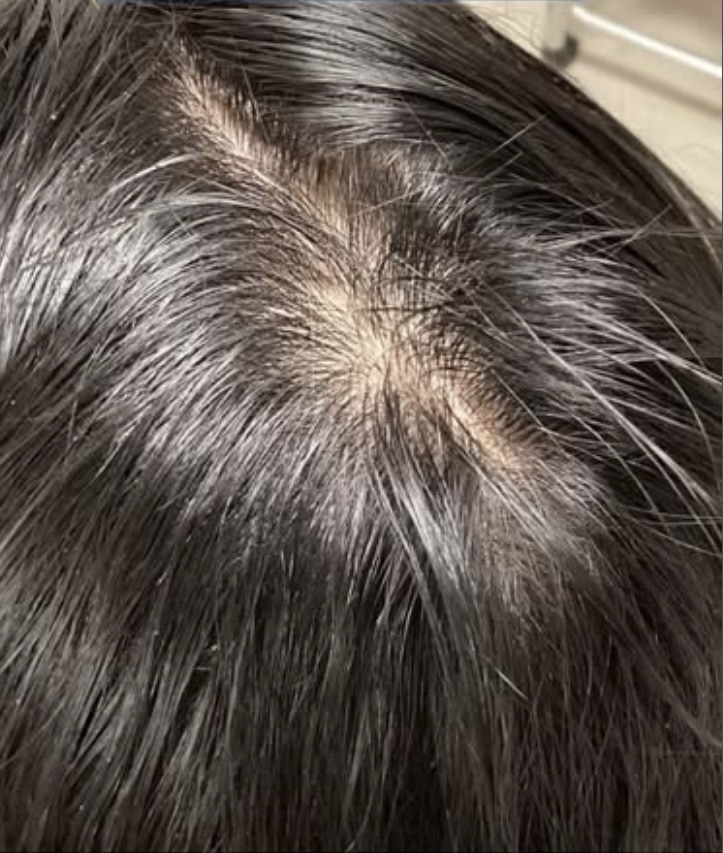 After Image: Hairloss - other