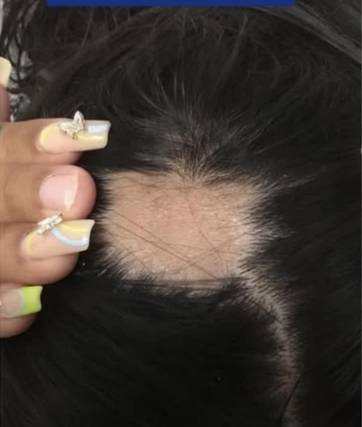 Before Image: Hairloss - other