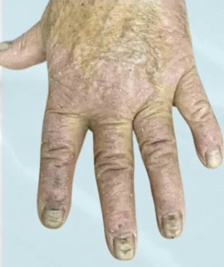 Before Image: Psoriasis - other