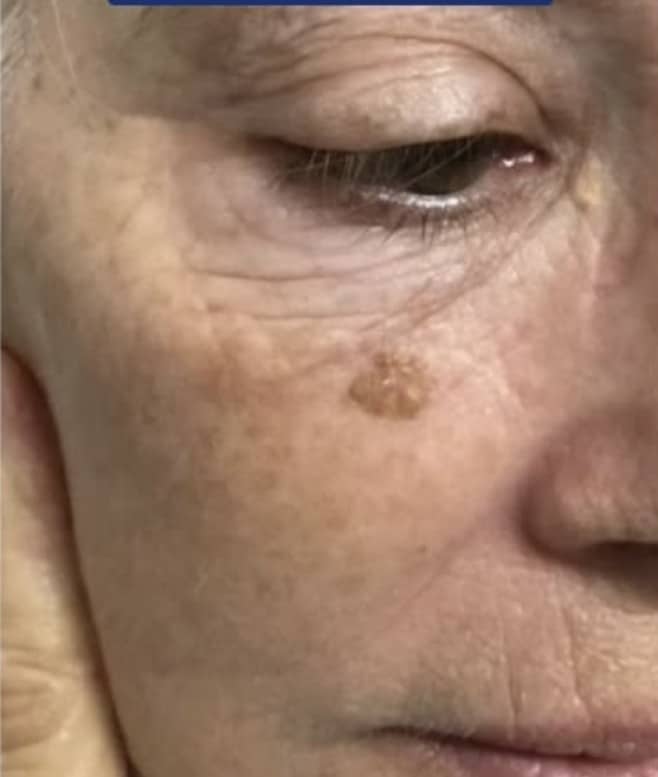 Before Image: Seborrheic Keratosis - right-front-oblique