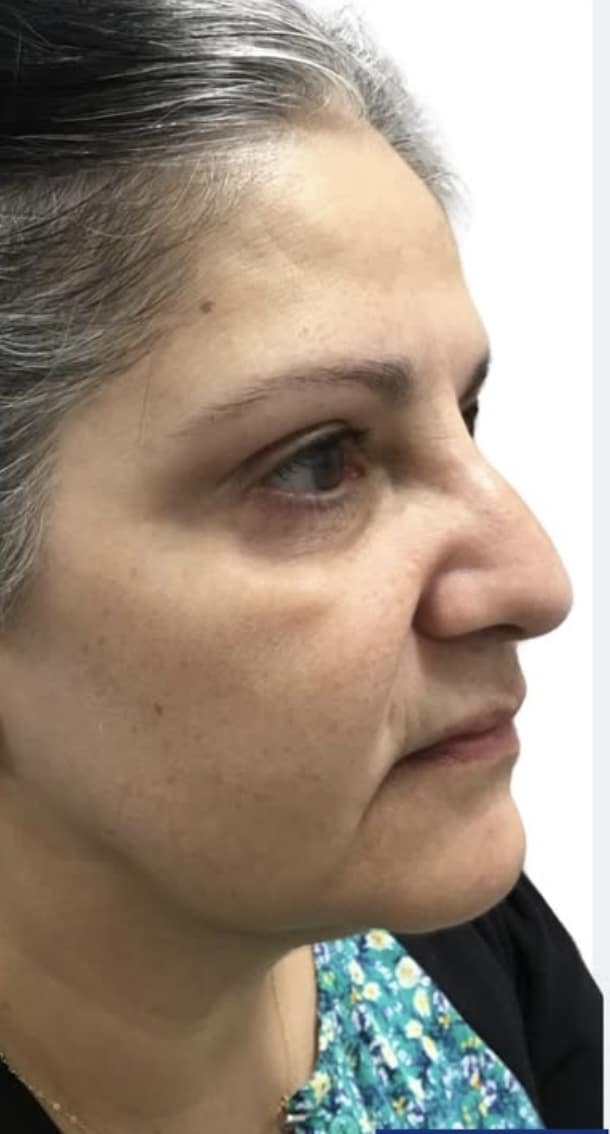 After Image: Solar Lentigos - right-side