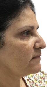 Before Image: Solar Lentigos