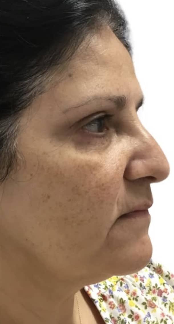 Before Image: Solar Lentigos - right-side