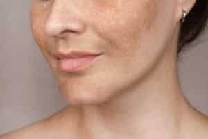 Close up of woman's face showing melasma hyperpigmentation