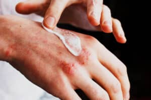 Person applying cream to red, irritated patches on the back of the hand caused by psoriasis.