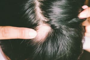 Bald spot showing on person with long hair due to alopecia
