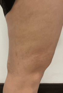 After Image: Sclerotherapy