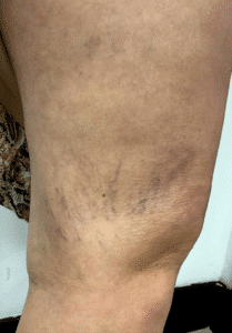 Before Image: Sclerotherapy