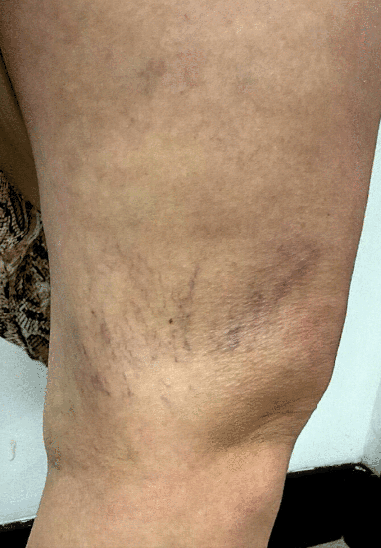 Before Image: Sclerotherapy - right-side