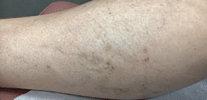 After Image: Sclerotherapy