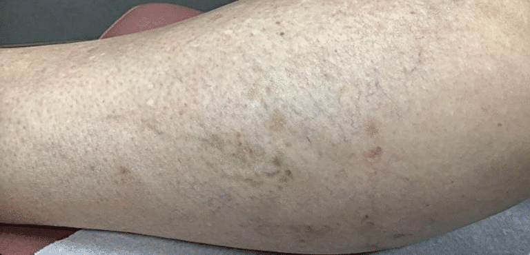 After Image: Sclerotherapy - left-side