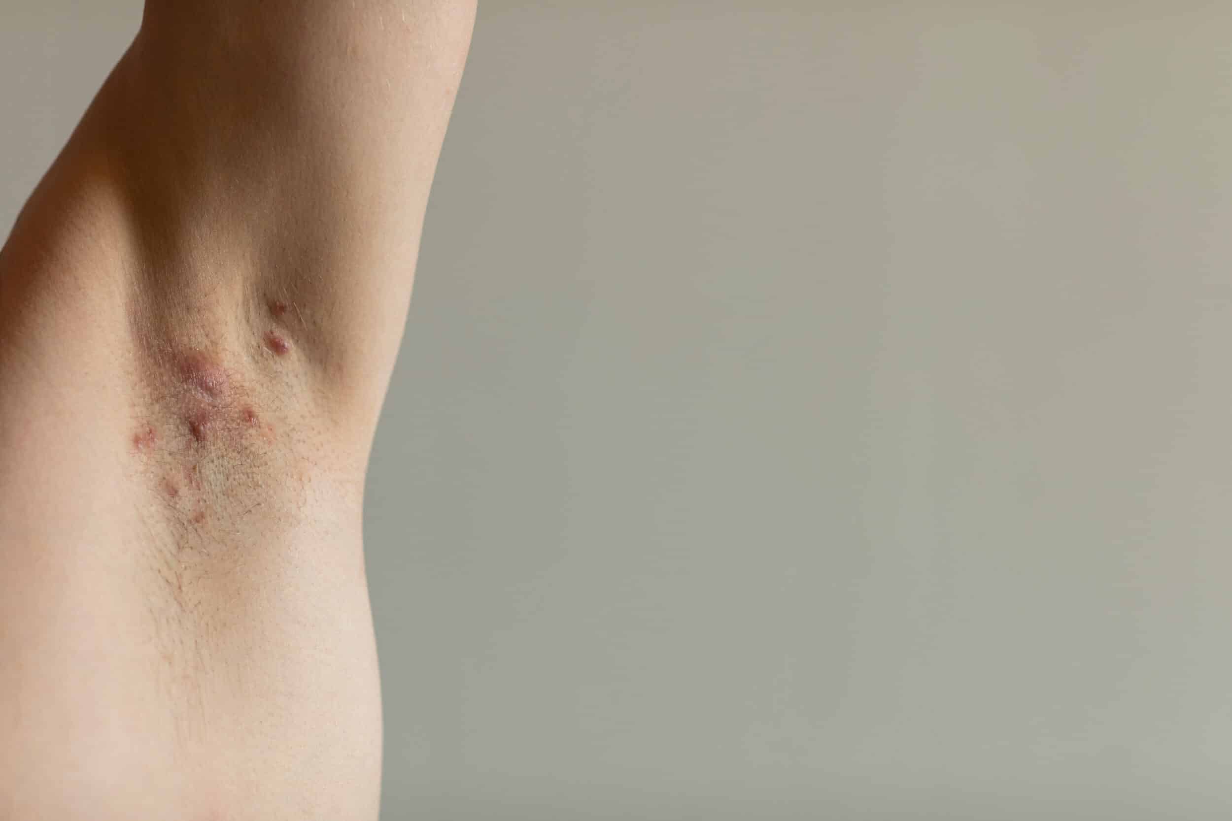 Tratamiento de la hidradenitis supurativa en el condado de Broward, Florida