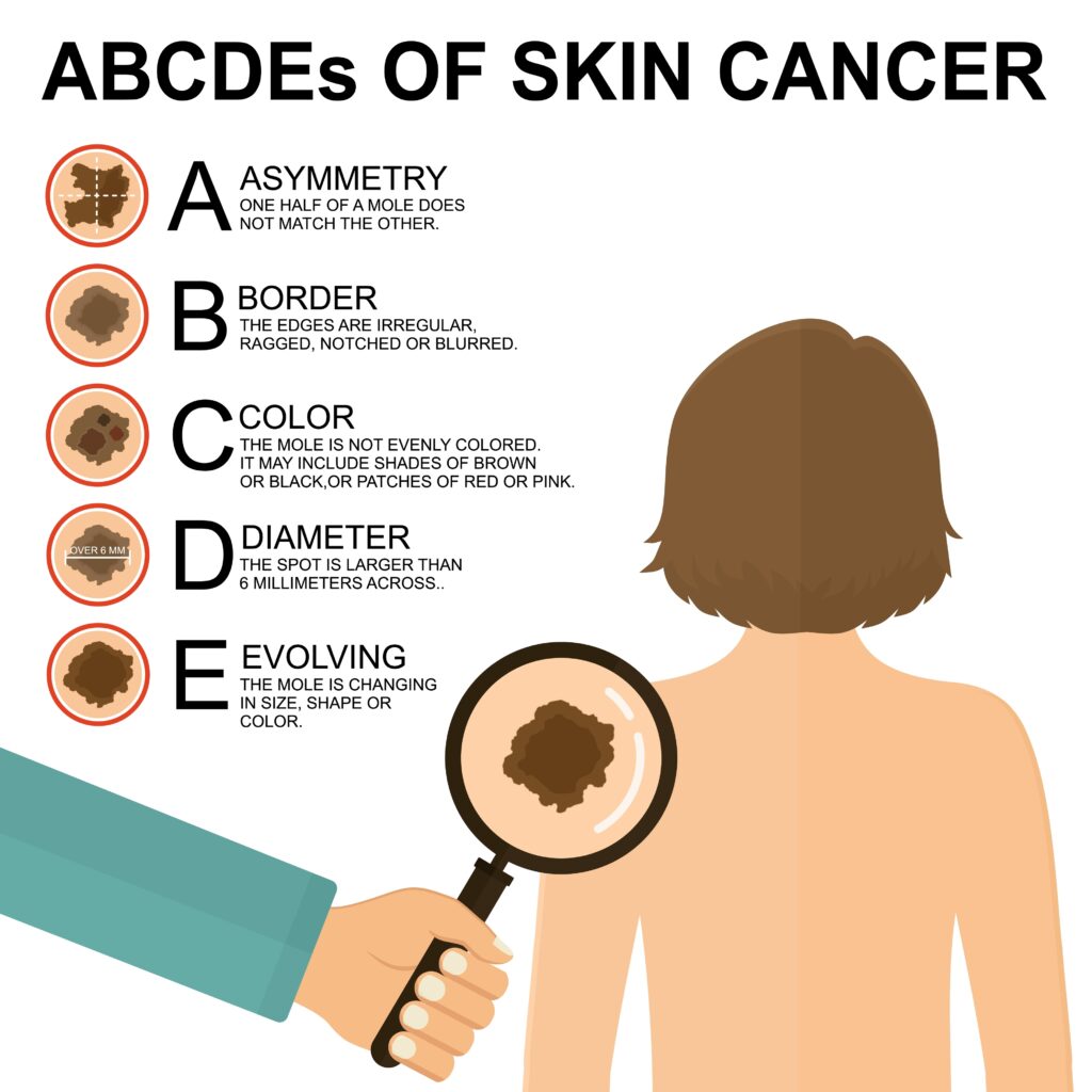Graphic chart showing the ABCDE Guide for spotting melanoma in Broward County, FL