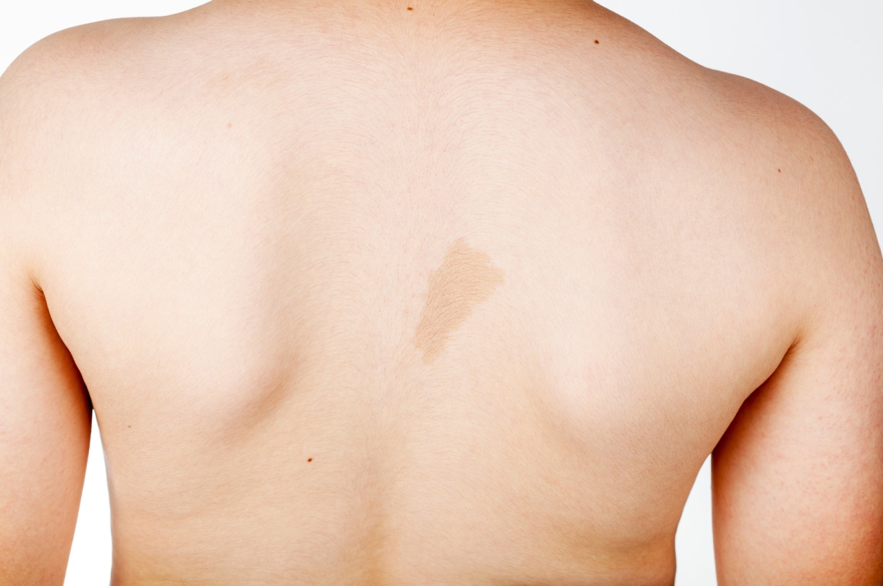 Light brown birthmark on a person’s upper back.