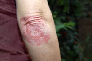 Close-up of red, scaly psoriasis plaques on an elbow.